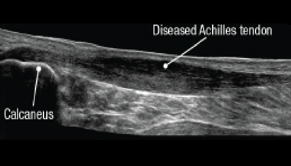 Diseased tendon appears thicker than healthy tendon
