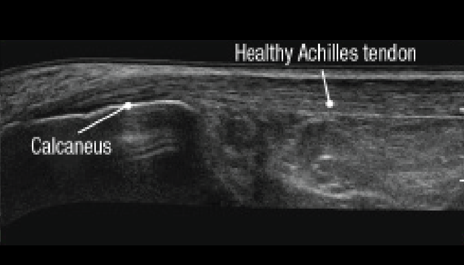 Immediately after Tenex showing healthy fibrillar structure pattern