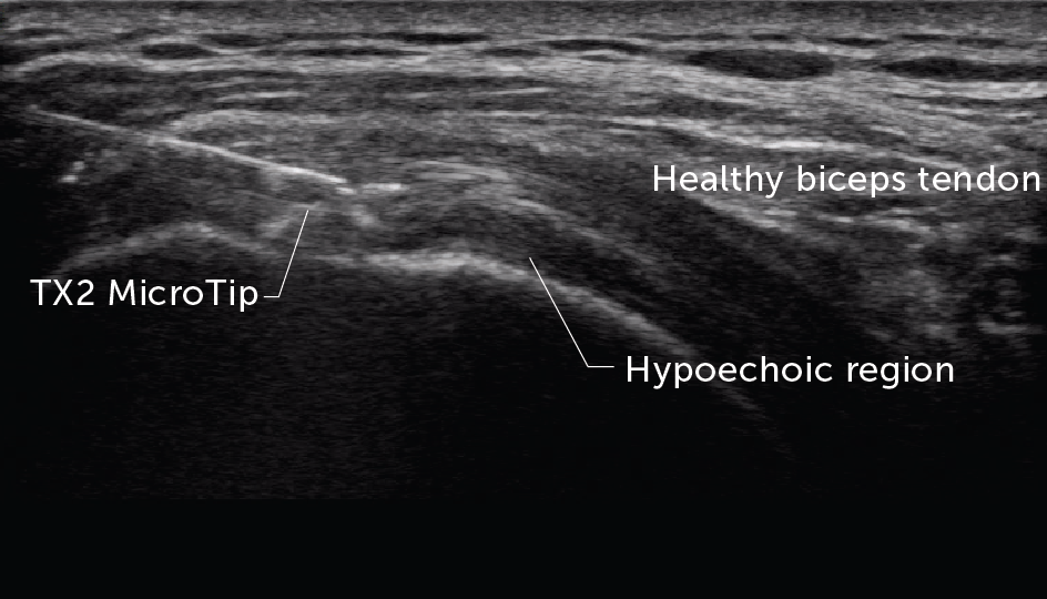 Tenex treating biceps tendon