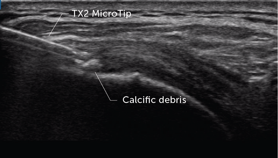 Tenex treating calcific debris
