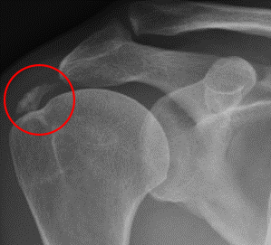 Calcific deposit in the supraspinatus tendon