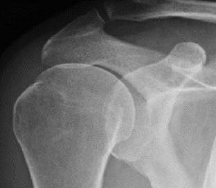Calcific deposit post-Tenex treatment