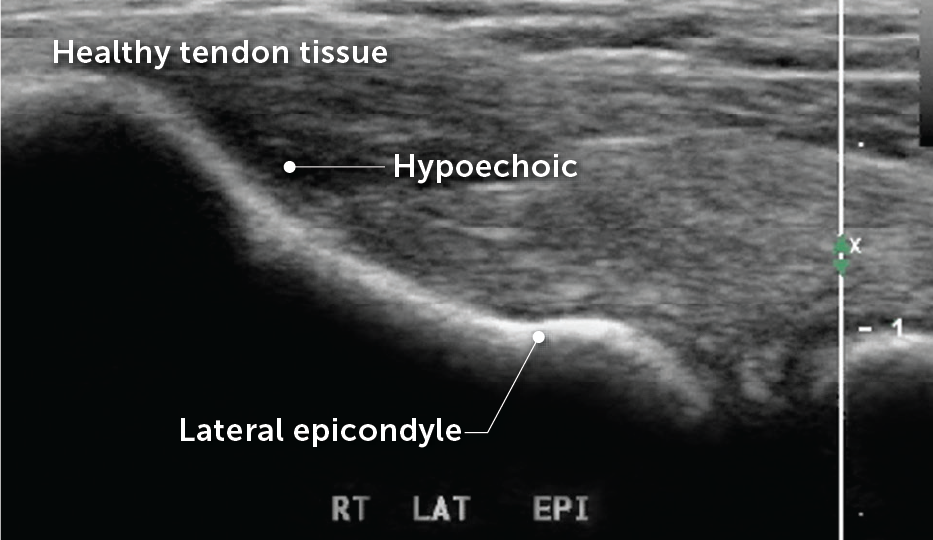 Diseased tissue appears as dark or hypoechoic