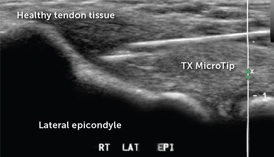Tenex treating diseased tendon tissue