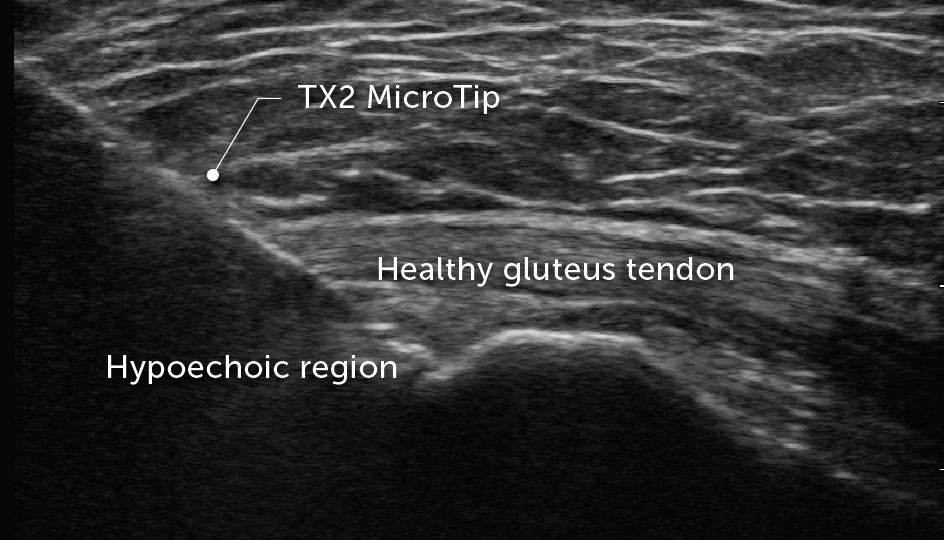 Tenex treating hypoechoic region in the gluteus
