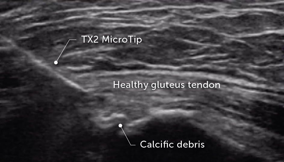 Tenex treating calcific debris