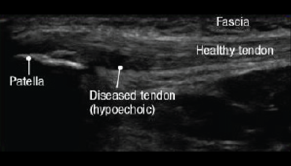 Diseased tissue appears as dark or hypoechoic