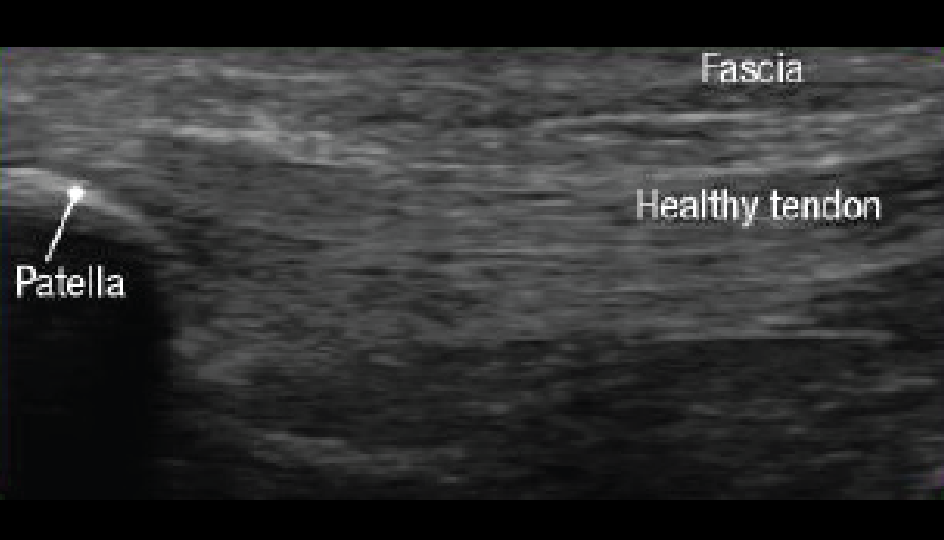 Immediately after treatment with Tenex with no dark regions