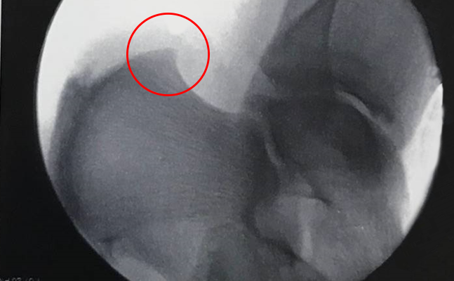 Calcaneal spur pre-treatment