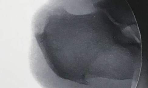 Calcaneal spur post-Tenex treatment