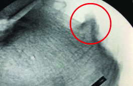Haglund's deformity before treatment