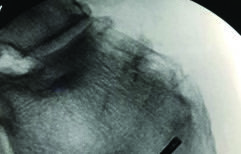 Haglund's deformity after treatment using Tenex