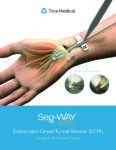 Surgical Technique Guide Seg-WAY ECTR