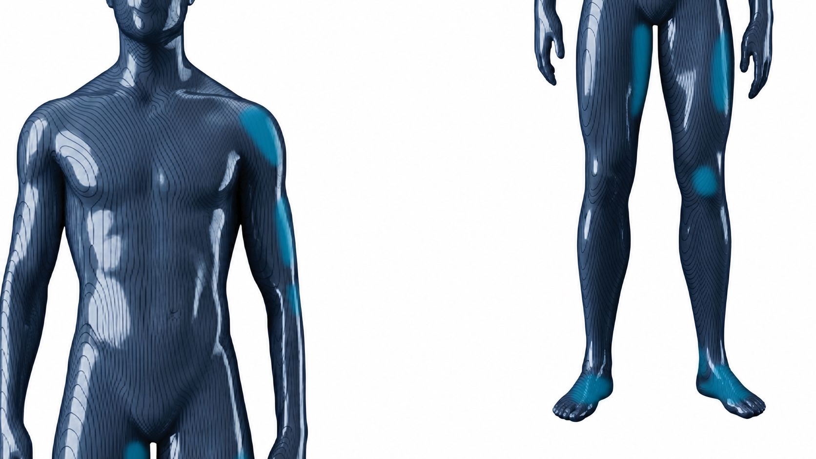 Anatomical illustration showing areas treated with the Tenex 2nd Generation System